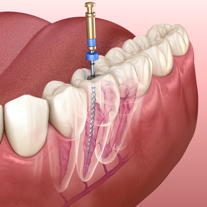 Endodonție image 1